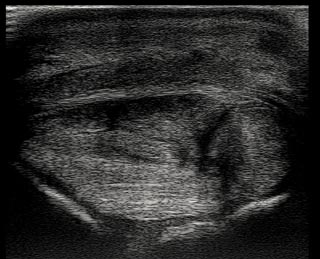 Figure 2a. Transverse ultrasound image of a severe injury to the superficial digital flexor tendon and deep digital flexor tendon of a horse. Despite analgesia provided by a combination of alpha-2 agonist, opioid and NSAID, the horse was non-weight-bearing lame without coaptation, but was sound at walk with a Robert Jones bandage.Figure 2a. Transverse ultrasound image of a severe injury to the superficial digital flexor tendon and deep digital flexor tendon of a horse. Despite analgesia provided by a combination of alpha-2 agonist, opioid and NSAID, the horse was non-weight-bearing lame without coaptation, but was sound at walk with a Robert Jones bandage.