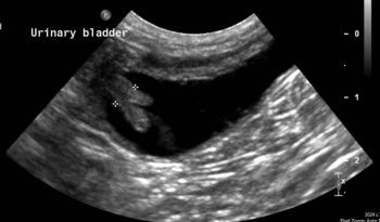 Figure 3. Ultrasonographic appearance of canine polypoid cystitis, showing a polyp on the ventral bladder wall.