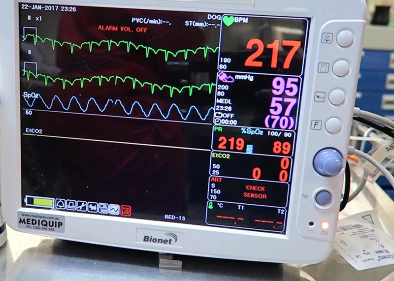 Pulse oximetry for a patient with hypoxaemia.