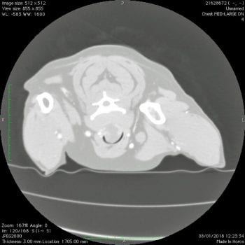 Figure 1. A transverse CT image of the distal cervical tracheal mass obstructing more than 80% of the lumen.
