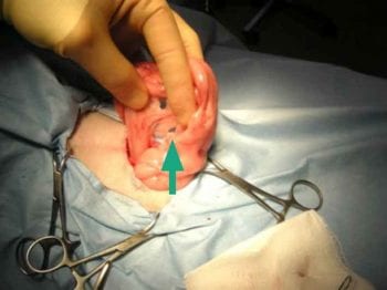 Figure 13. Select an avascular window (green arrow) in the broad ligament caudal to the ovarian vessels.