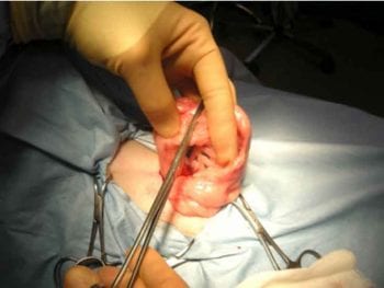 Figure 14. A large pair of forceps are placed across the proximal uterine horn, near the ovary ligament (the surgeon’s left thumb is on top of the ovary).