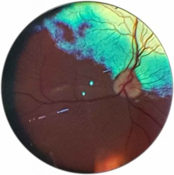 Figure 6. A view with indirect ophthalmoscopy. An overview of the fundus.