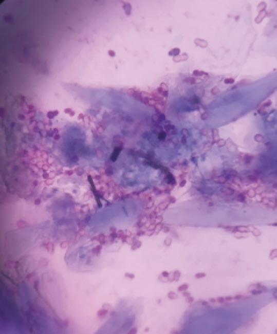 Figure 1. Case one palmar aspect of the paw showing a large number of peanut shaped Malassezia. Stained with modified Romanowsky stain and ×1,000 magnification.