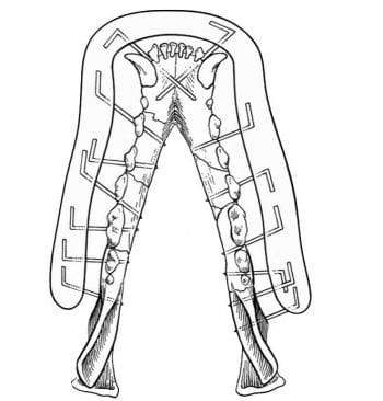 Figure 6. A modified acrylic external skeletal fixator. Image: DeCamp et al, 2016.