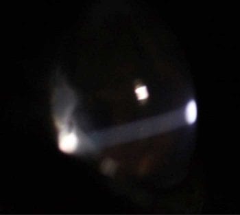 Figure 2. Aqueous humor flare in the anterior chamber.