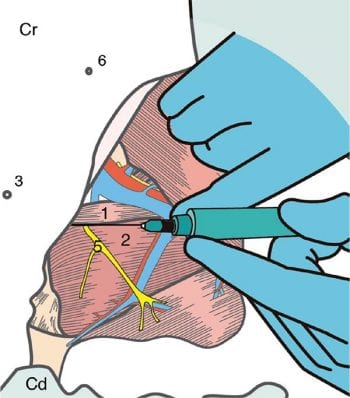 Figure 2. An illustration of the obturator nerve block technique. 1 = pectineus muscle; 2 = adductor muscle; 3 = inguinal nipple; 5 = obturator nerve; 6 = caudal abdominal nipple; Cr = cranial; Cd = caudal.