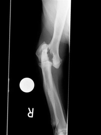 Figure 1. Preoperative craniocaudal radiograph of the right elbow.