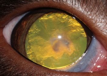 Figure 5. Immature cataract affecting the whole lens with tapetal reflection still present.