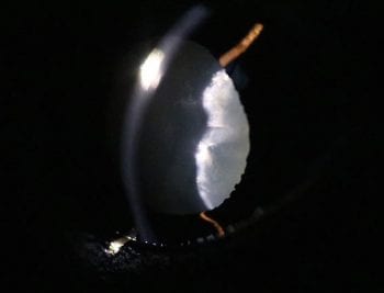 Figure 7. Hypermature cataract.