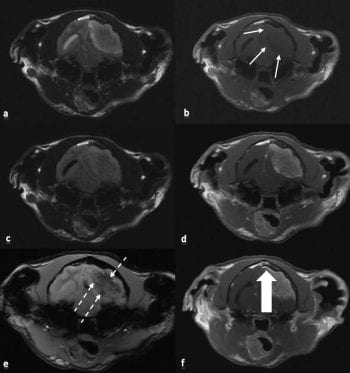 Figure 2. Transverse images of the extra-axial lesion at the level of the mesencephalon. (a) The lesion appeared markedly heterogeneously hyperintense compared to grey matter in T2-weighted images. (b) Hypo-isointense compared to grey matter in T1-weighted images; the thin arrows delineate the lesion. (c) T2-FLAIR images allowed to differentiate secondary effects (mainly oedema). (d) T1-weighted images post-contrast showed mild heterogenous enhancement and marked peripheral enhancement. (e) T2-gradient echo images were used to visualise haemorrhage. The haemorrhages appeared black on these images and are indicated by the dashed arrows. (f) T1-weighted post-contrast image at the level of the rostral colliculus showed dural tail indicated by thick arrow.