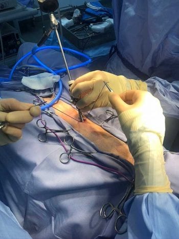 Figure 2. Initial port placement using a modified Hassan approach.