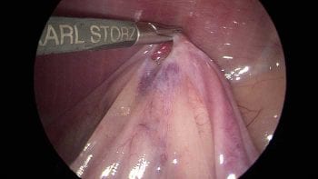 Figure 3. Grasping ovary at level of ovarian bursa with laparoscopic Allis tissue forceps.