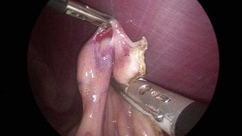 Figure 4. Bipolar vessel sealing device in use.