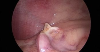 Figure 5. Inspection of the pedicle after the ovary has been removed.
