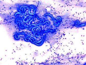 Figure 2. Bronchoalveolar lavage, dog (Wright-Giemsa 20×). Note the presence of frequent Angiostrongylus vasorum larvae admixed with leukocytes, mostly neutrophils.