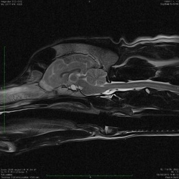 Figure 2. Sagittal flair image post-contrast showing a hyperintense structure arising from the sella turcica (arrowheads).