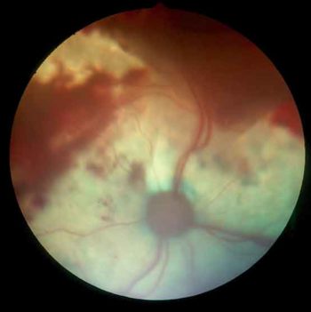Figure 10. Hypertensive retinopathy.