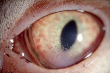 Figure 7. Chonic anterior uveitis.
