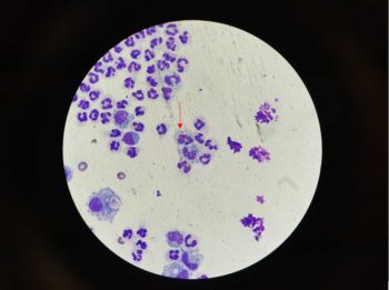 Figure 3. Septic inflammatory exudate with intracellular bacteria (red arrow).