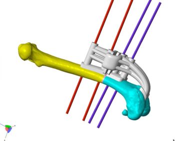 Figures 2 and 3. Computer-aided design images showing the virtual osteotomy and guides required to perform this osteotomy. Image: Bill Oxley,Vet 3D