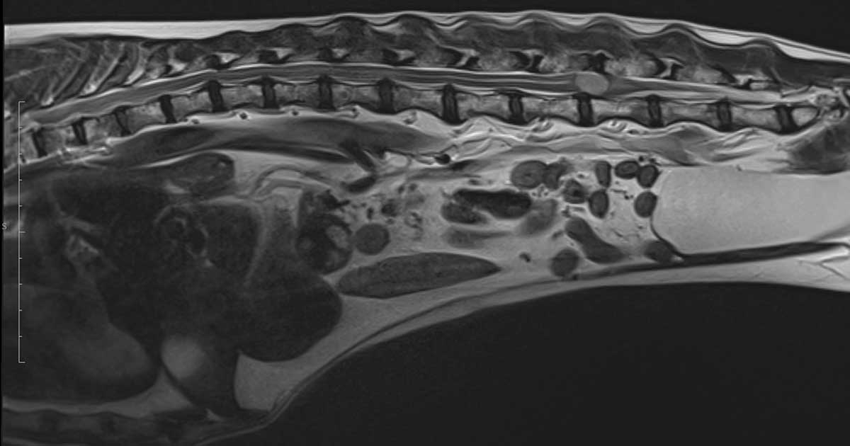 The T2-weighted sagittal scan shows high signal lesion at L4/L5 disc space.