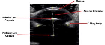 Figure 6. This B-mode image shows the ultrasonographic appearance of some anterior ocular structures. The highly echogenic curved appearance of the anterior and posterior lens capsules can be visualised.