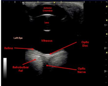 Figure 7. This B-mode image shows the ultrasonographic appearance of parts of the eye, including the optic disc and some of the retrobulbar structures. The depth scale to the right of the image shows small yellow arrowheads to denote the position of the focal zones. The focal zone should be set at the level of, or just below, the area of interest. Some ultrasound machines can enable multiple focal zones, which improves the image resolution. However, this can reduce the frame rate of the display.
