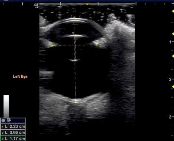 Figure 9. In this B-mode image, biometry measurements of the globe (digital calliper line 1, from the anterior cornea to the posterior globe) and lens (calliper line 2, from the anterior to the posterior lens capsule; and line 3, measuring lens width) are shown.