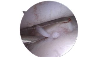 Figure 5. An arthroscopic image of the medial coronoid fragment in situ, elevated with a needle.