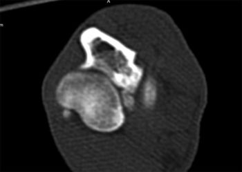 Figures 1 and 2. Multiplanar reconstructions of the elbow CT showing a fragmented medial coronoid process and a humeral intracondylar fissure with new bone formation on the lateral epicondyle bridging across and poorly defined fracture line.