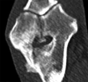 Figure 2. Multiplanar reconstructions of the elbow CT showing a fragmented medial coronoid process and a humeral intracondylar fissure with new bone formation on the lateral epicondyle bridging across and poorly defined fracture line.