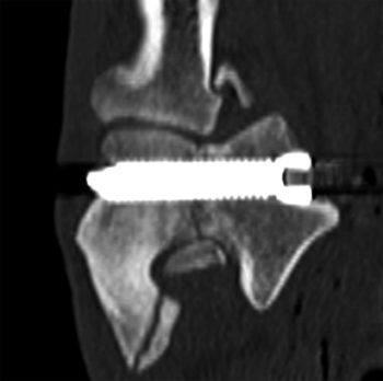 Figure 6. A postoperative CT scan shows the 5mm screw in place across the condyle.