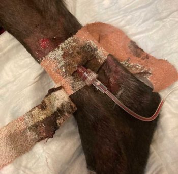 An infected IV catheter site with signs of local inflammation and discharge.