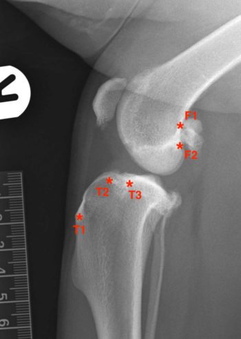 Figure 9. Femoral and tibial anchorage sites for placement of a quasi-isometric extracapsular suture. F1: on the caudal aspect of the femoral condyle at the level of the proximal pole of the fabella. F2: on the caudal aspect of the femoral condyle at the level of the distal pole of the fabella. T1: at the level of the patellar ligament insertion. T2: at the level of the cranial wall of the long digital extensor groove of the tibia. T3: at the level of the caudal wall of the same long digital extensor groove of the tibia.