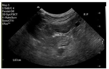 Figure 1. Abdominal ultrasound image documenting an enlarged right pancreatic limb with surrounding hyperechoic mesentery.