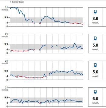 Interstitial glucose curves from the same dog showing the effect of switching to protamine zinc insulin.