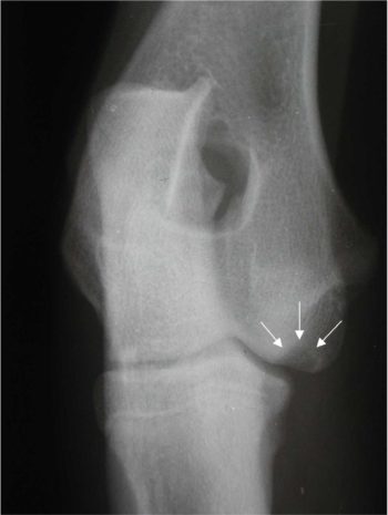 Figure 4. Osteochondritis dissecans of the medial humeral condyle (arrows).